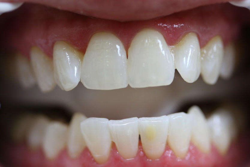 after-whitening