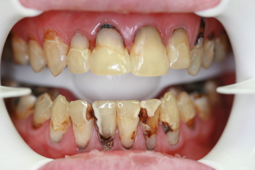damaged-teeth