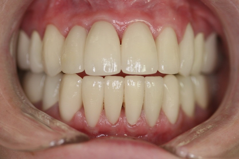 repaired-teeth